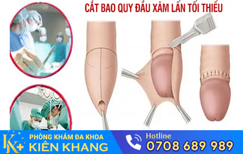 Cắt bao quy đầu xâm lấn tối thiểu hiện đại hiệu quả vượt trội