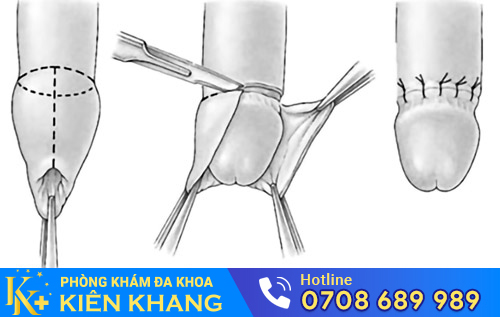 Cắt bao quy đầu bằng kỹ thuật hiện đại được xem là phương pháp tiên tiến hiện nay