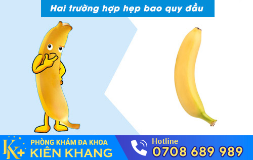 Hai dạng hẹp bao quy đầu