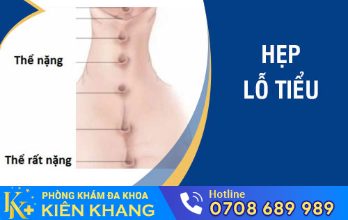 hẹp lỗ tiểu