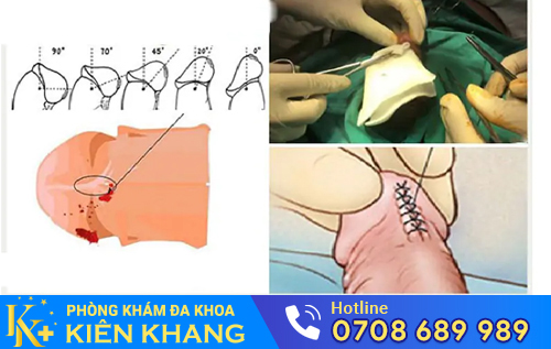 Hình ảnh hỗ trợ điều trị rách dương vật