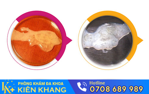 Hình ảnh tinh trùng đặc, tinh trùng vón cục