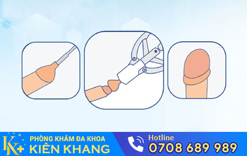 Cắt bao quy đầu