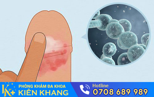 Nấm dương vật