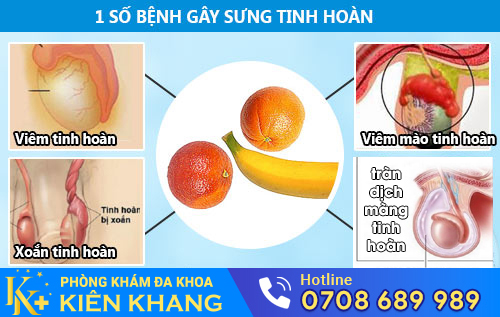 Sưng tinh hoàn là biểu hiện của nhiều bệnh nam khoa nguy hiểm