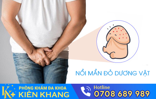 Dương vật bị nổi mẩn đỏ do nguyên nhân nào?