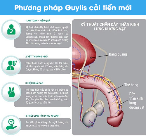 Phương pháp Guylis cải tiến mới