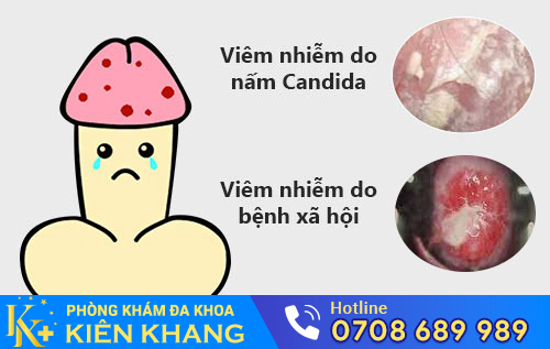 Viêm nhiễm do nấm Candida, bệnh xã hội