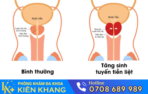 Tăng sinh tuyến tiền liệt