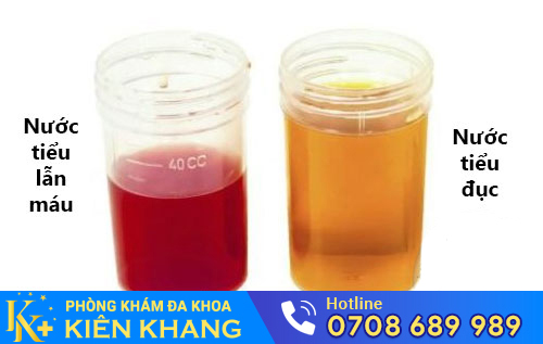 Nước tiểu đục, có lẫn máu là triệu chứng viêm đường tiết niệu ở nam và nữ