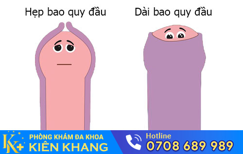 Phân biệt dài/hẹp bao quy đầu