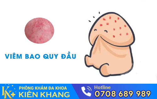 Đau buốt quy đầu do viêm bao quy đầu