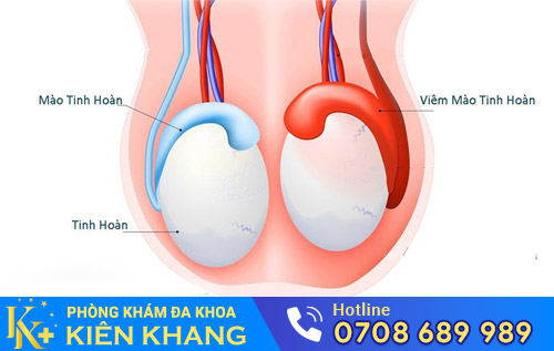 Viêm mào tinh hoàn