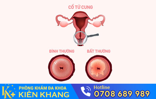 Viêm cổ tử cung