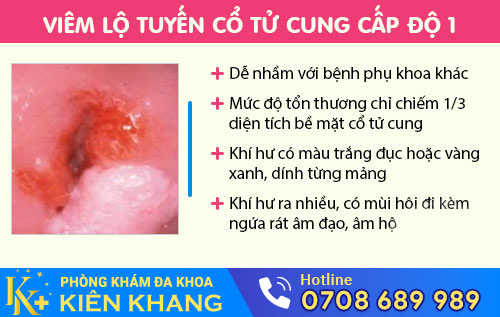 Viêm lộ tuyến cổ tử cung cấp 1
