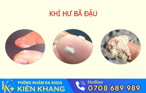 Hiện tượng khí hư bả đậu