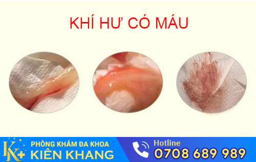 Khí hư có máu