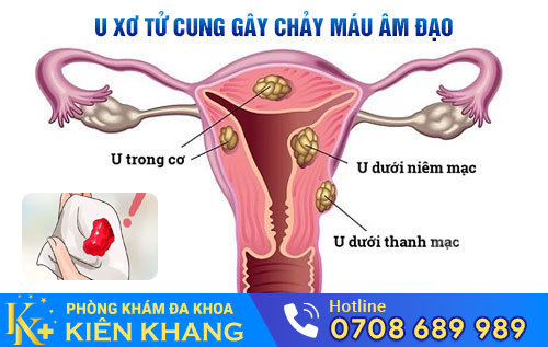 Nguyên nhân gây chảy máu âm đạo