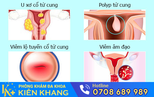 Nguyên nhân ra máu khi quan hệ
