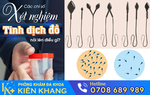 Xét nghiệm tinh dịch đồ