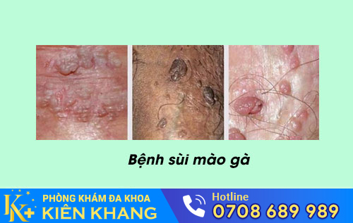Sùi mào gà