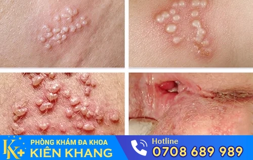 bieu hien benh mun rop sinh duc