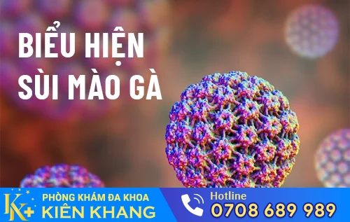 bieu hien cu the cua benh sui mao ga