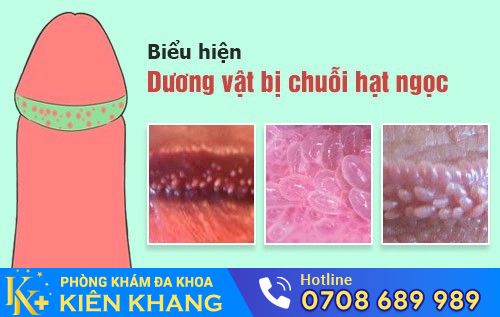 Chuỗi hạt ngọc dương vật