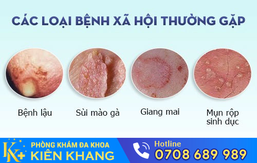 Các bệnh xã hội thường gặp