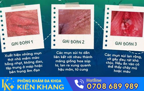 Biểu hiện sùi mào gà qua 3 giai đoạn bệnh
