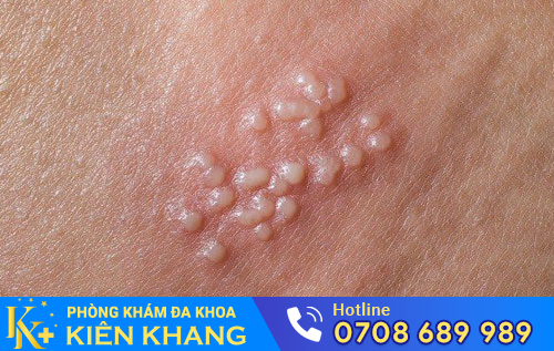 Mụn rộp sinh dục