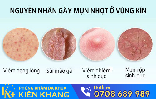 Một số nguyên nhân gây mụn nhọt vùng kín