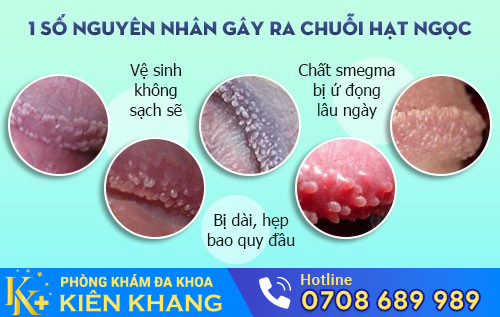 Hình ảnh chuỗi hạt ngọc dương vật