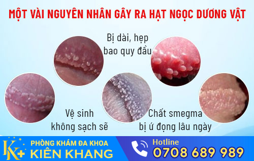 nguyen nhan gay ra hat ngoc duong vat
