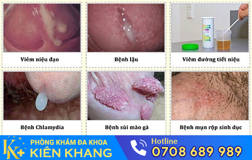 Niệu đạo chảy mủ là dấu hiệu của nhiều bệnh lý nguy hiểm