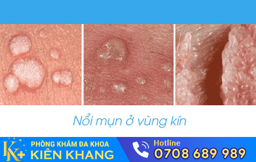 Hình ảnh nổi mụn ở vùng kín