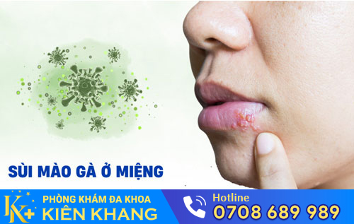 Sùi mào gà ở miệng