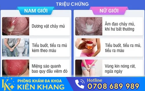 trieu chung benh lau
