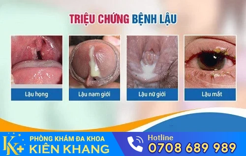 trieu chung benh lau
