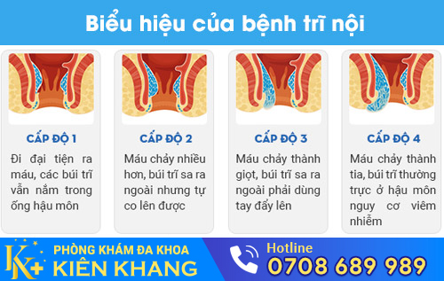 Biểu hiện bệnh trĩ nội