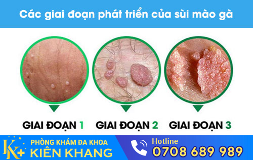 Các giai đoạn phát triển của sùi mào gà