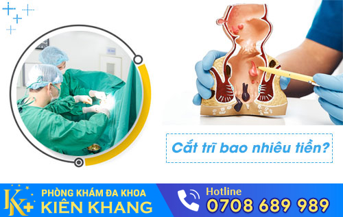 Cắt trĩ bao nhiêu tiền?