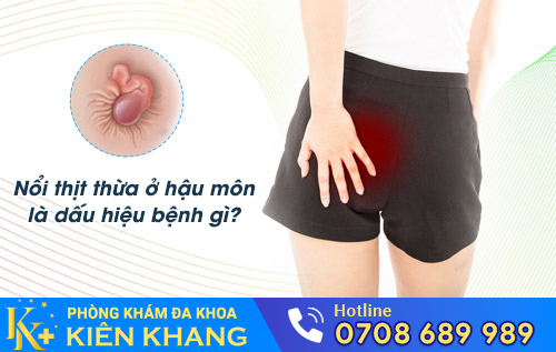 Nổi thịt thừa ở hậu môn