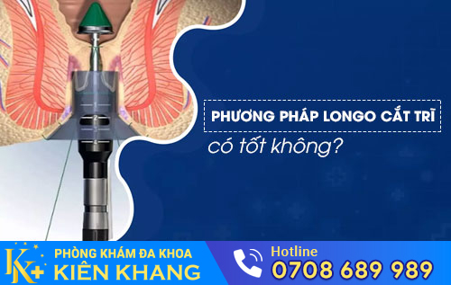 Phương pháp longo cắt trĩ có tốt không?