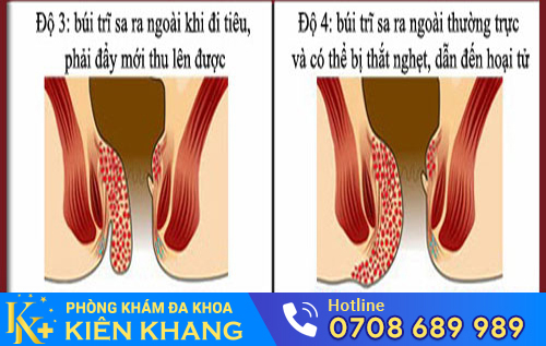 Biểu hiện của bệnh trĩ ngoại độ 3, độ 4