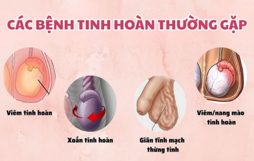 Một số bệnh tinh hoàn thường gặp ở nam giới