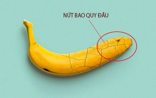 Nứt bao quy đầu phần lớn do nguyên nhân bệnh lý