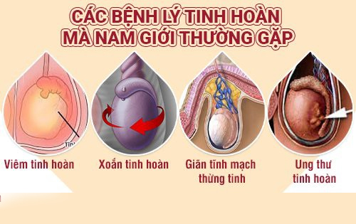 Các bệnh tinh hoàn thường gặp ở nam giới