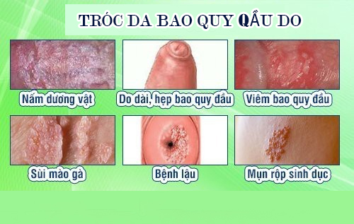 Tróc da bao quy đầu dấu hiệu cảnh báo nhiều bệnh lý